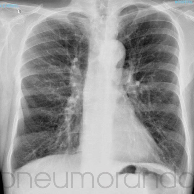 Dpoc E Hiperinsufla O Radiografia De T Rax Pneumorando